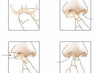 DILITATOR PROTIV HRKANJA – 3 KOM
