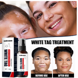 Krema protiv Vitiliga