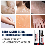 Krema protiv Vitiliga