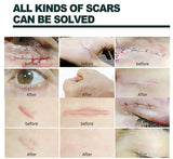 Krema za Uklanjanje Strija i Ožiljaka