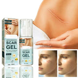 Krema za Uklanjanje Strija i Ožiljaka