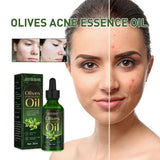 Maslinovo ulje za lečenje akni i uklanjanje mitesera