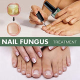 Esencija za uklanjanje gljivica na noktima