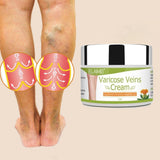Specijalna krema protiv proširenih (varikožnih vena) i neutralisanje bolova u nogama